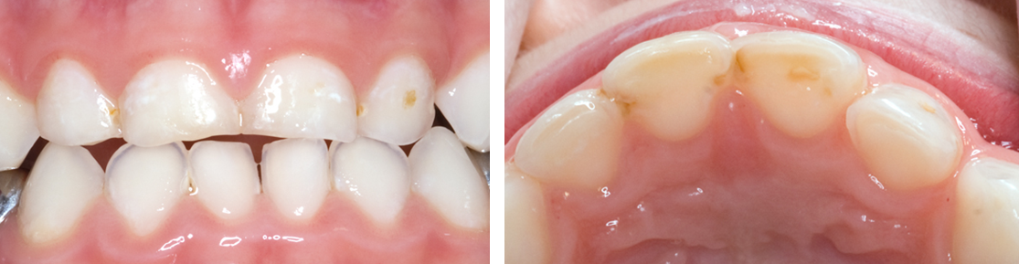 Minor Dental Caries